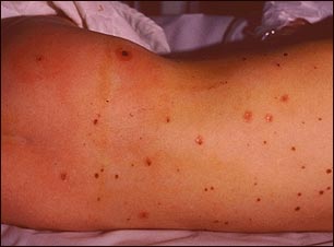 Lesiones meningoc&oacute;cicas en la espalda