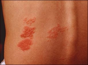 Herpes zoster (culebrilla) en la espalda