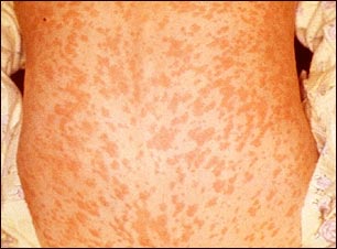 Sarampi&oacute;n en la espalda