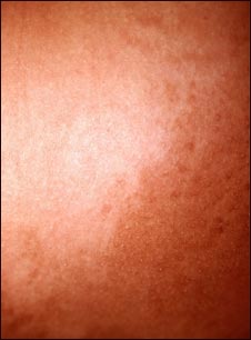 Hiperpigmentaci&oacute;n 2