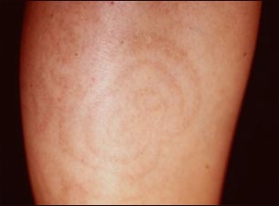 Hiperpigmentaci&oacute;n posinflamatoria en la pantorrilla