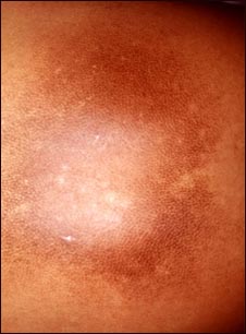 Hiperpigmentaci&oacute;n posinflamatoria 2