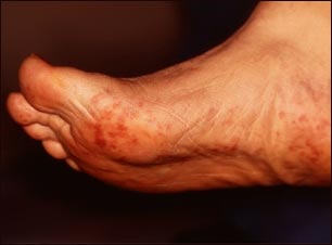&Eacute;mbolos de colesterol del Livedo reticularis en los pies