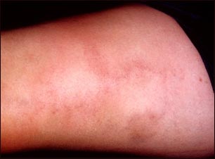 Tromboflebitis superficial