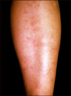 Poliarteritis microsc&oacute;pica 2