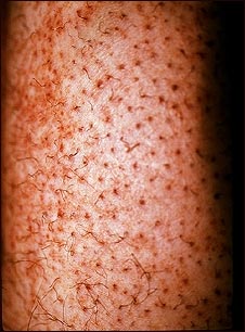 Escorbuto; pelo ensortijado