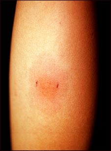 Examen de piel positivo con relaci&oacute;n a la cantidad de cigarrillos consumidos diariamente