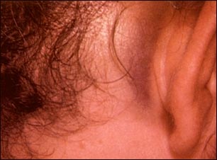 Signos de Battle detr&aacute;s de la oreja