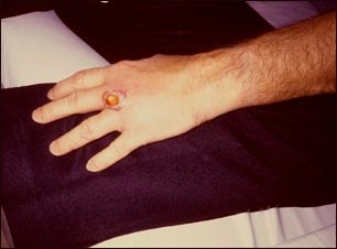 Picadura de una ara&ntilde;a reclusa parda en la mano