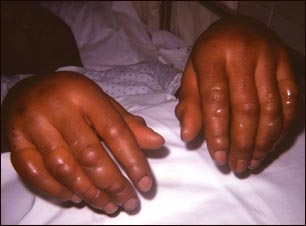 Congelaci&oacute;n de las manos