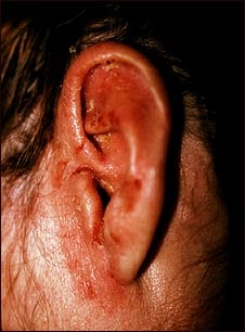 Ti&ntilde;a corporal en el o&iacute;do