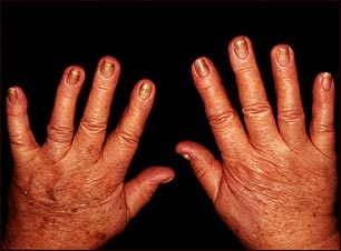 U&ntilde;as amarillas