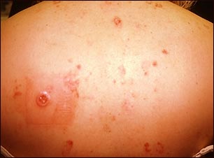 C&aacute;ncer m&uacute;ltiple de c&eacute;lula basal por terapia con rayos X para el acn&eacute;