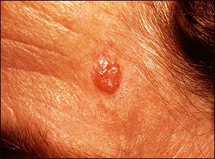 Carcinoma de c&eacute;lula basal en la cara