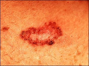 Vista de cerca de un carcinoma de célula basal