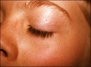 S&iacute;ndrome de nevo de c&eacute;lulas basales