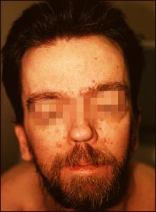 S&iacute;ndrome de nevo de c&eacute;lulas basales- cara