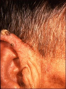 Queratosis act&iacute;nica en el o&iacute;do