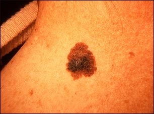 Melanoma del cuello