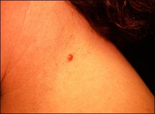 Queratosis seborreica irritada en el cuello