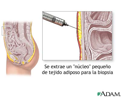 Biopsia de tejido graso