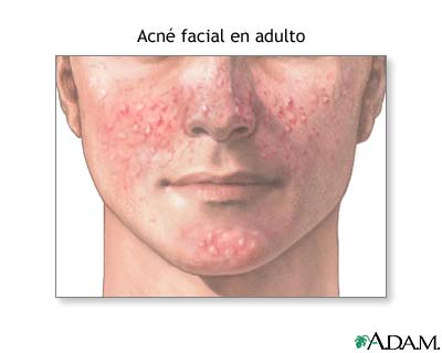 Acn&eacute; facial del adulto