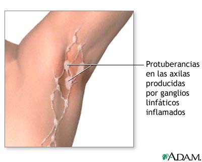Ganglios linf&aacute;ticos inflamados debajo del brazo