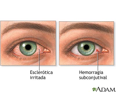 Ojos inyectados de sangre