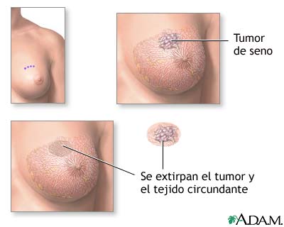 Excisi&oacute;n de un tumor en el seno