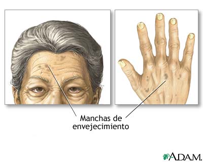Manchas de envejecimiento