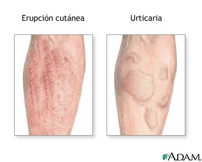 Reacciones al&eacute;rgicas