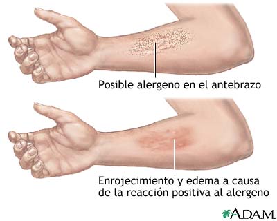Reacci&oacute;n positiva a un alergeno