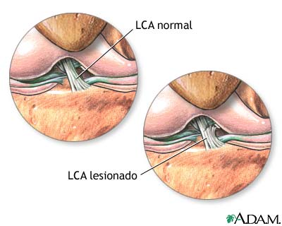 Lesi&oacute;n del ligamento cruzado anterior (LCA)