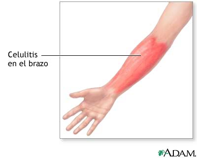 Celulitis en el brazo