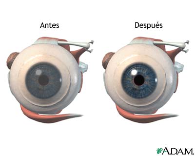 Antes y despu&eacute;s de cirug&iacute;a corneal