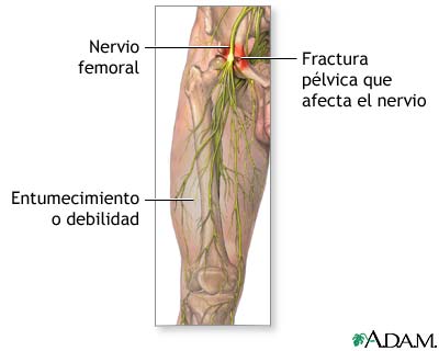 Daño al nervio femoral