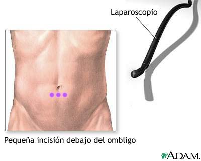 Incisi&oacute;n para realizar laparoscopia abdominal