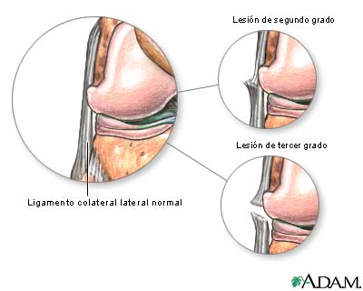 Lesi&oacute;n del ligamento colateral lateral