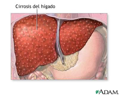 Cirrosis del h&iacute;gado