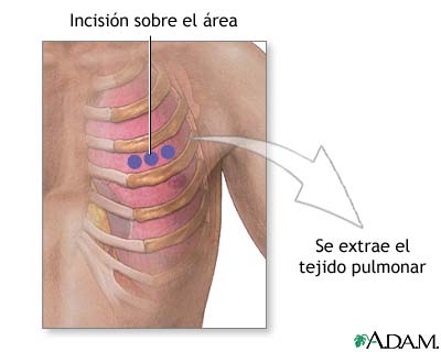 Incisi&oacute;n para biopsia de pulm&oacute;n