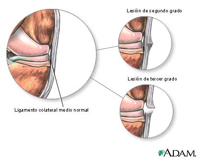 Lesi&oacute;n del ligamento medial colateral