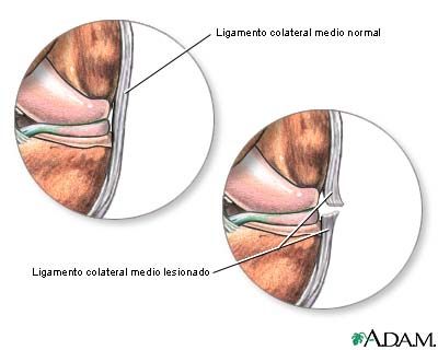 Ligamento medial colateral desgarrado