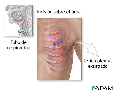Incisi&oacute;n para biopsia de tejido pleural