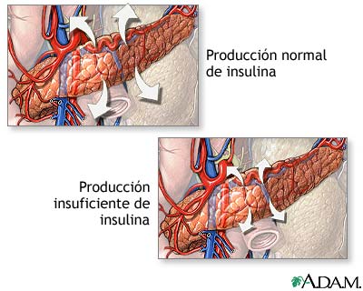 Producci&oacute;n de insulina y diabetes