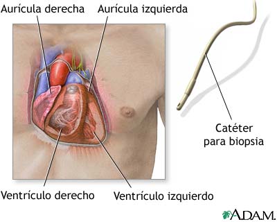 Cat&eacute;ter para biopsia