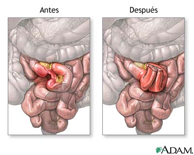 Antes y despu&eacute;s de anastomosis del intestino delgado