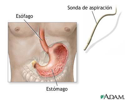 Examen de &aacute;cido estomacal