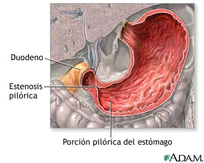 Estenosis pil&oacute;rica