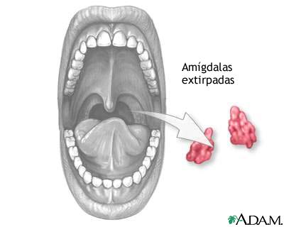 Tonsilectom&iacute;a