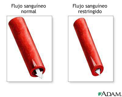 Vasoconstricci&oacute;n